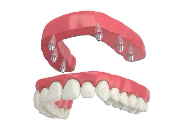 Best veneers teeth in Surat