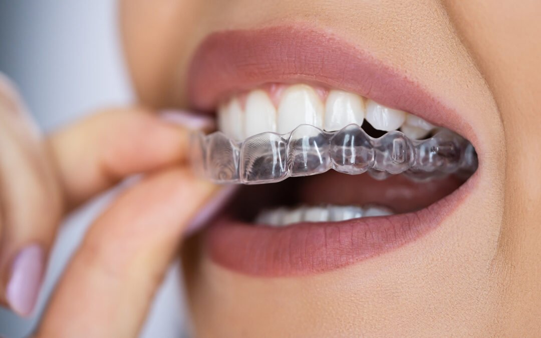 Best Invisible Braces Doctor in Surat