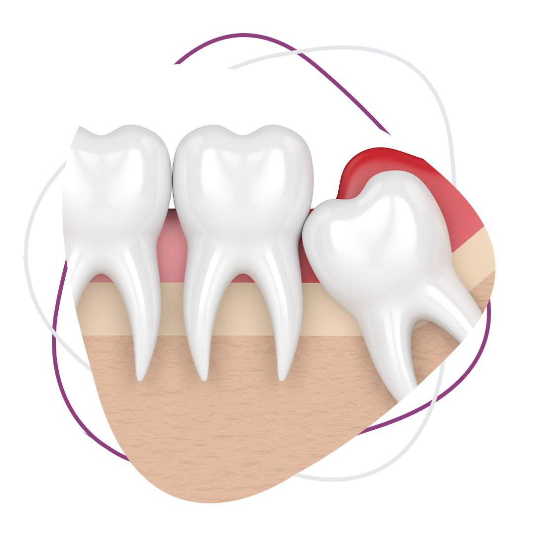 Wisdom Tooth Removal