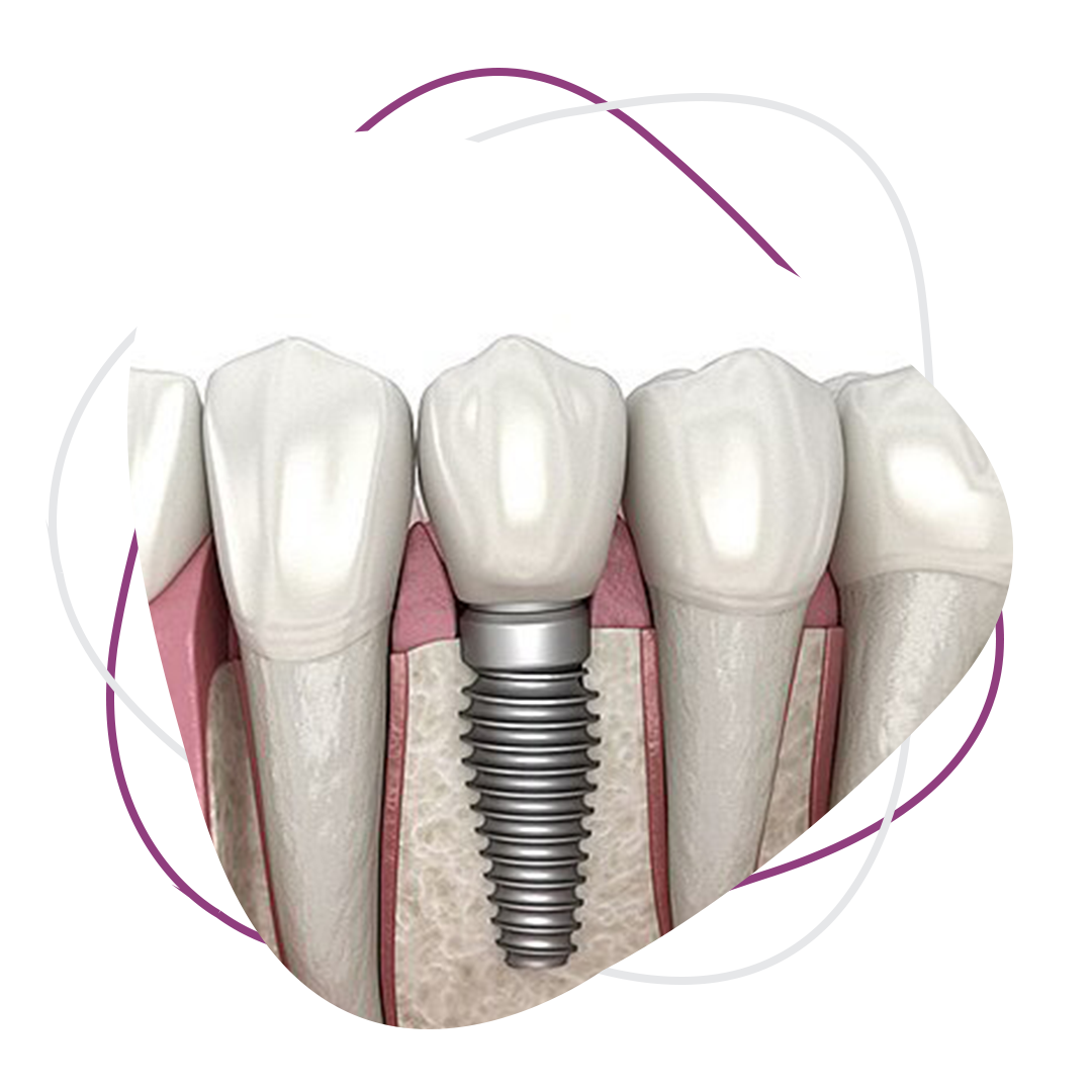 dental implants  
